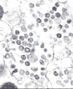 sars - s-a-r-s - severeacuterespiratorysyndrome - severe acute respiratory syndrome